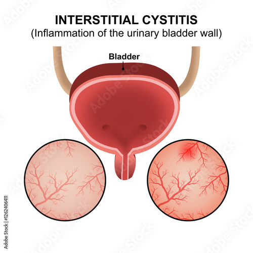 Interstitial Cystitis , Inflammation in the Urinary Bladder Wall Illustration