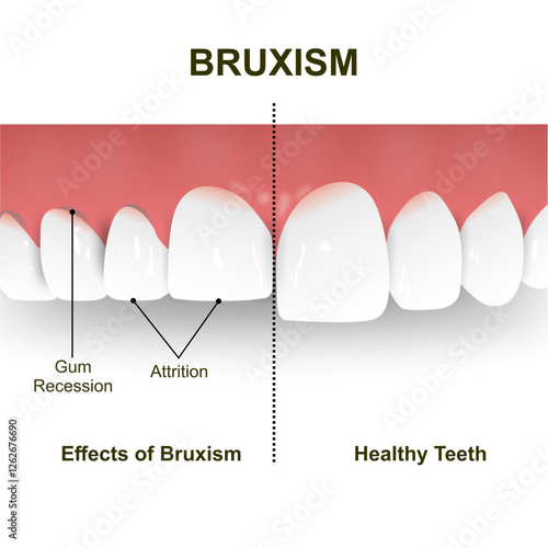 Bruxism Tooth Illustration, Normal vs  Effect of Bruxism