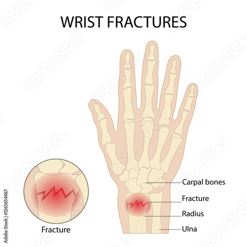 Anatomy of the hand radial dislocation aseptic necrosis displacement fracture painful fall