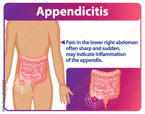 Understanding Appendicitis and Its Symptoms