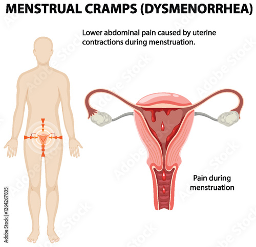 Understanding Menstrual Cramps and Dysmenorrhea