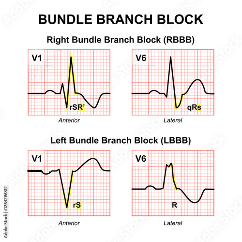 Bundle Branch Block | LBBB, RBBB Illustration