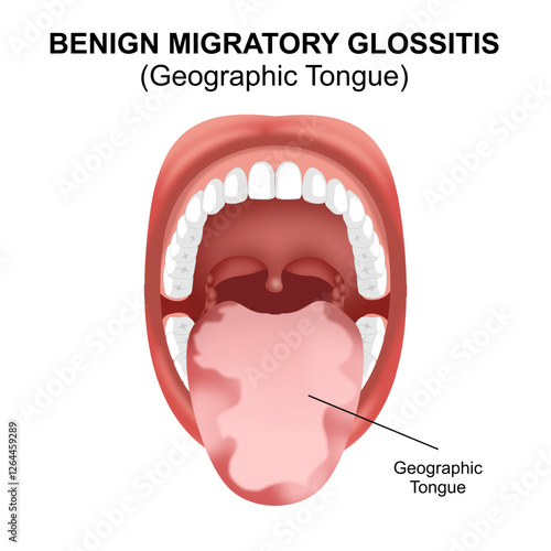 Benign Migratory Glossitis (Geographic tongue)