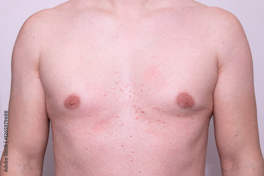 Close up of man chest with red, inflamed skin rashes. Could be case of contact dermatitis, allergic reaction, or fungal infection