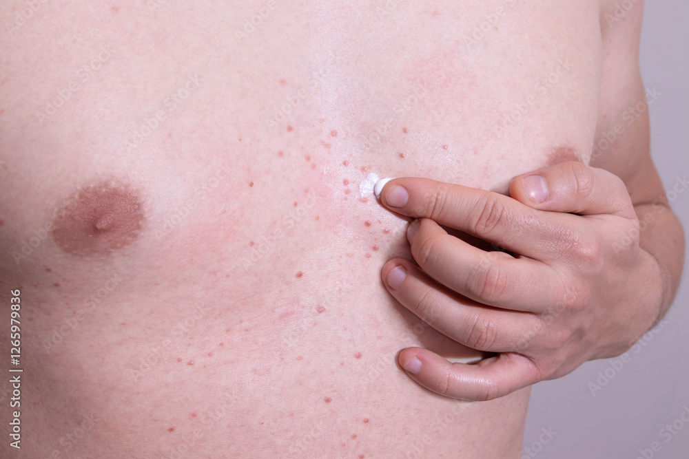 Fototapeta premium Man applying medicated cream to red skin rashes on his chest. Dermatological treatment. Skin rashes treatment