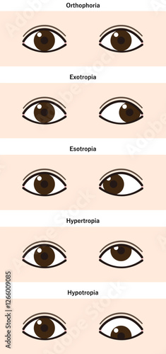 斜視の種類　一覧　イラスト（Strabismus）