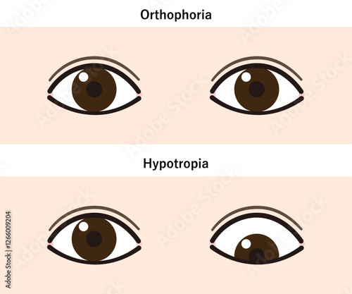 下斜視のイラスト（Strabismus/Hypotropia）