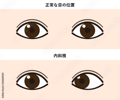 内斜視と正常な目の比較イラスト