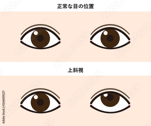上斜視と正常な目の比較イラスト