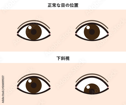 下斜視のイラスト