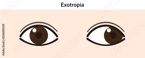 外斜視のイラスト（Strabismus/Exotropia）