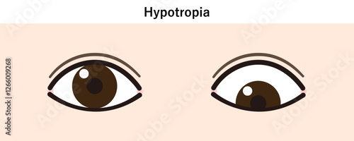 下斜視のイラスト（Strabismus/Hypotropia）