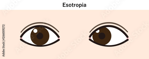 内斜視のイラスト（Strabismus/Esotropia）