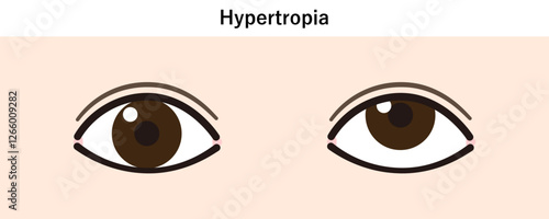上斜視のイラスト（Strabismus/Hypertropia）