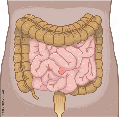 Diverticulum・ meckel diverticulum・small intestine・colon・illustration