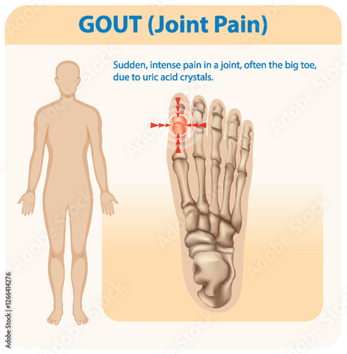Understanding Gout and Joint Pain