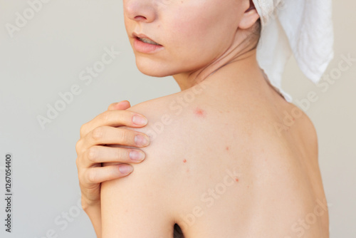 Young woman suffering acne on her back, demonstrating a big pimple on her shoulder blade. Skin diseases. Hormonal disorders.
