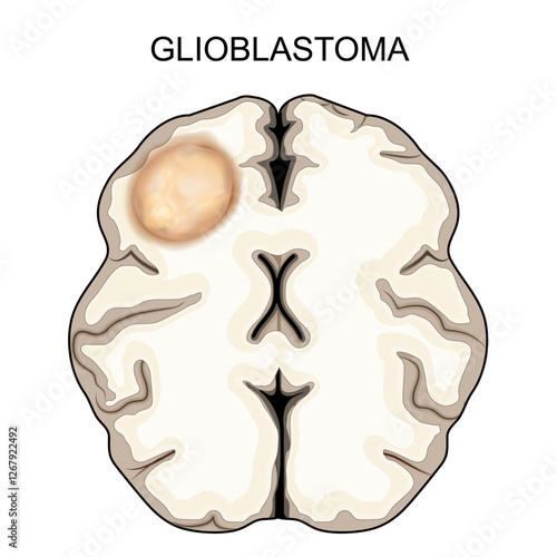 Glioblastoma. Brain tumor. Malignant cancer.