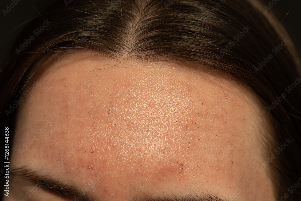Close-up of skin after laser resurfacing – CO2 fractionated laser.