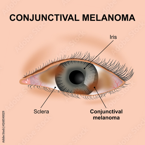 Conjunctival Melanoma rare Eye Cancer Illustration