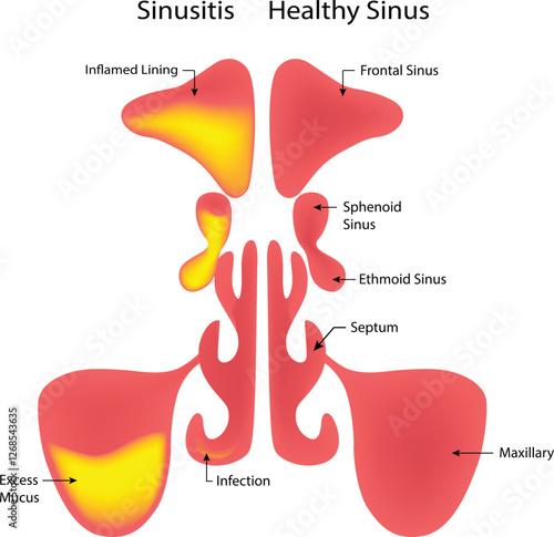 Sinusitis Healthy Sinus Science Design Vector Illustration Diagram