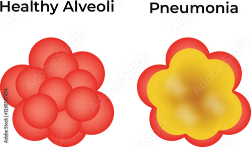 Healthy Alveoli Pneumonia Science Design Vector Illustration Diagram