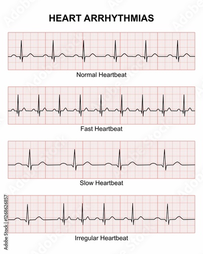 Heart Arrhythmias, Cardiac rhythm illustration