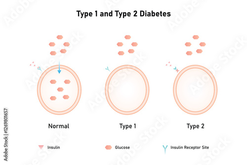 Type 1 and Type 2 Diabetes Science Design. Vector Illustration.