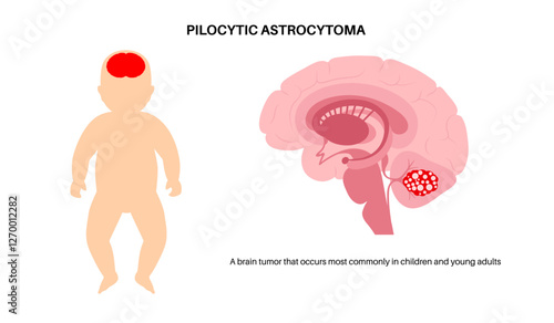 Pilocytic astrocytoma poster