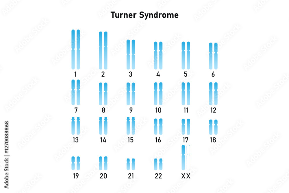Turner Syndrome Science Design. Vector Illustration. Turner Syndrome Science Design. Vector Illustration.