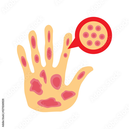 Kaposi sarcoma