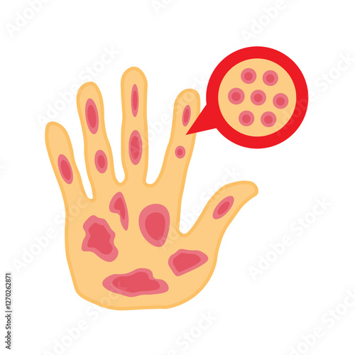 Kaposi sarcoma