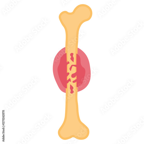 Ewing sarcoma