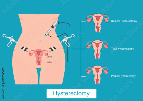 A hysterectomy is a surgical procedure to remove the womb.