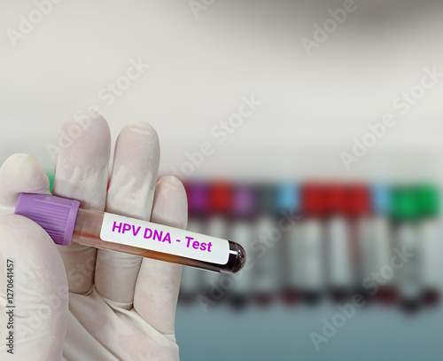 Tablou pe pânză Scientist hold blood sample test tube for  HPV DNA test with laboratory background