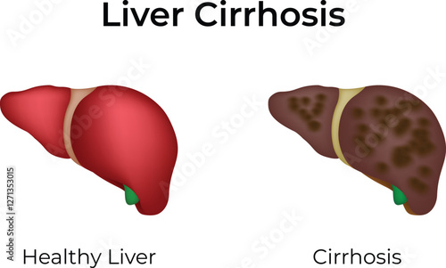 Liver Cirrhosis Healthy vs Diseased Liver Design Vector Illustration