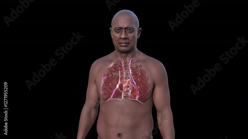 A man with lungs affected by silicosis. 3D animation revealing dark silicotic nodules, emphasizing respiratory health issues due to silica exposure.