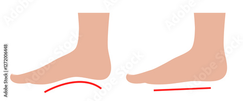 Flat feet. Normal foot and flat foot. Vector illustration.