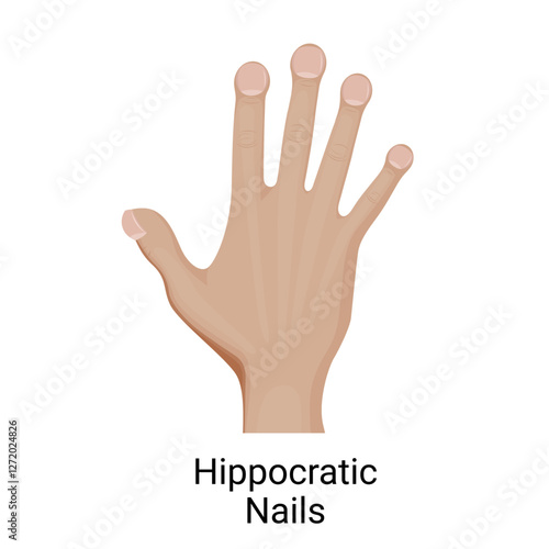 Fingernail clubbing or hippocratic nails on the hand.