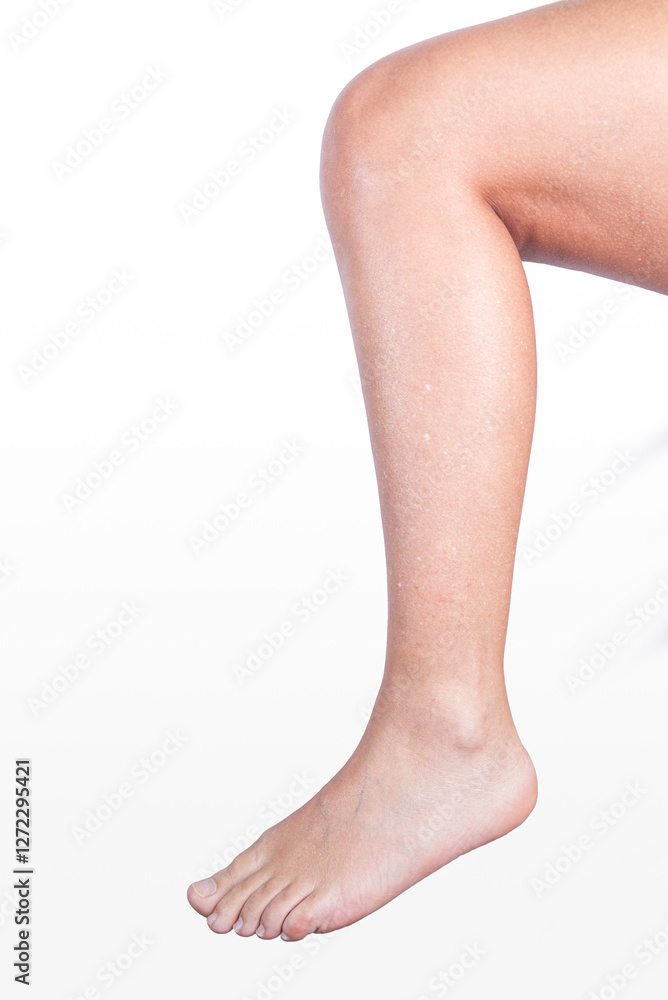 Caucasian woman with hypomelanosis on the skin of her legs. Dermatological diseases. Copy space, diseases, skin medical treatment. Stains.
Caucasian woman with hypomelanosis on the skin of her legs. Dermatological diseases. Copy space, diseases, skin medical treatment. Stains.