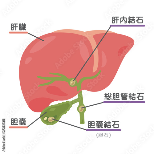 結石ができた胆嚢と肝臓のイラスト2