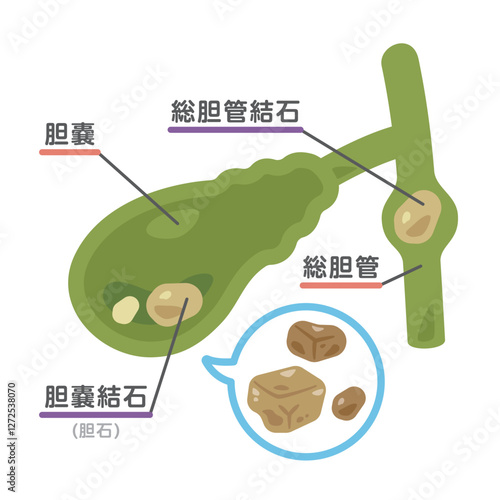胆石ができた胆嚢のイラスト3