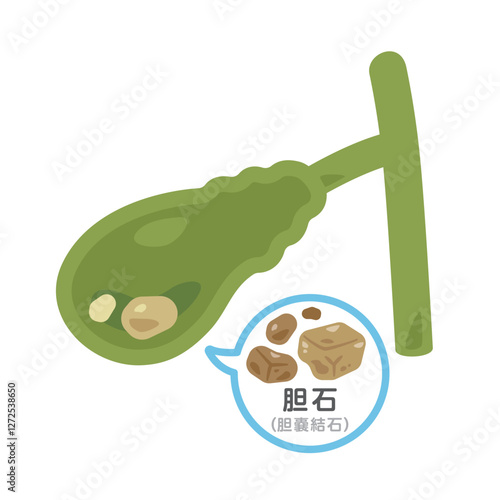 胆石ができた胆嚢のイラスト2