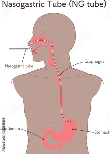 胃ドレナージ、Nasogastric tube