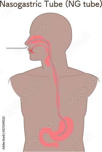 胃ドレナージ、Nasogastric tube
