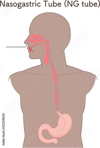 胃ドレナージ、Nasogastric tube