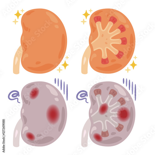 健康でキレイな腎臓と炎症が起きた不健康な腎臓のイラスト