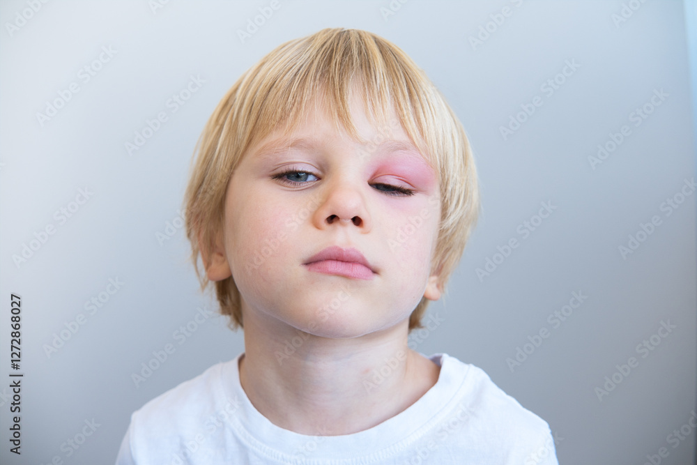 close up little boy with allergic red spot at face cause by mosquito bite close up little boy with allergic red spot at face cause by mosquito bite