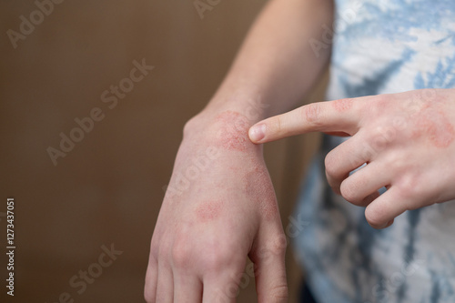 Cold dermatitis on a child's arm. How to treat peeling on your hands during the cold season. Close-up.
