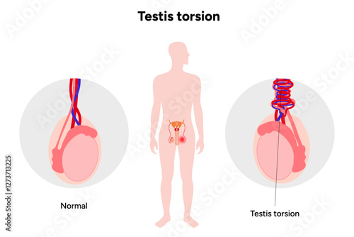 Testis torsion Testicular disease. Man reproductive health system pain testicle pathology problem. Medical diagram 